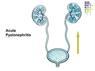 Acute
Pyelonephritis
 