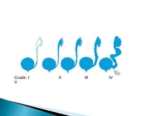 Grade: I II III IV
V
 