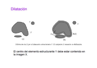 Dilatación
 
