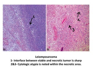 Leiomyosarcoma
1- Interface between viable and necrotic tumor is sharp
2&3- Cytologic atypia is noted within the necrotic area.
 