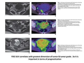 FDG SUV correlates with greatest dimension of tumor & tumor grade . So it is
important in terms of prognostication
 