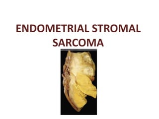 ENDOMETRIAL STROMAL
SARCOMA
 