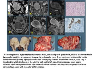 A-F:Homogeneous hyperintense intrauterine mass, enhancing with gadolinium,invades the myometrium
Lymphadenopathies are present, Surgery : large irregular mass Gross specimen: endometrial cavity
completely occupied by a polypoid lobulated tumor gray and dun with white areas (4,5x3,5 cm). It
invades the whole thickness of the uterine wall on the left side. On microscopic exam poorly
differentiated areas predominate over areas of adenocarcinoma with squamous spots mixed with
sarcomatous areas with muscular differentiation
 