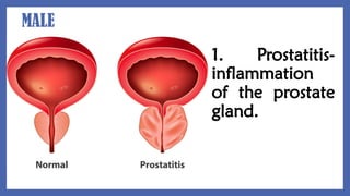 MALE
1. Prostatitis-
inflammation
of the prostate
gland.
 