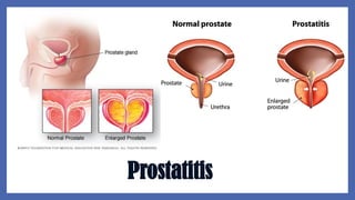 Prostatitis
 