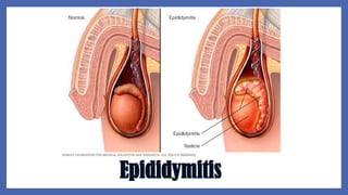 Epididymitis
 