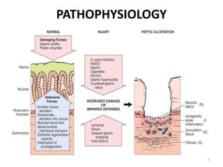 PATHOPHYSIOLOGY
5
 