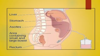ABDOMINAL PARACENTESIS | PPTX