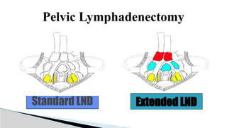 Utuc Ribbon UTUC & MUSCLE INVASIVE BLADDER CA POWERPOINT PRESENTATION | PPTX