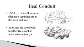 Utuc Presentation UTUC & MUSCLE INVASIVE BLADDER CA POWERPOINT PRESENTATION | PPTX