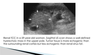 Utuc Presentation UTUC & MUSCLE INVASIVE BLADDER CA POWERPOINT PRESENTATION | PPTX