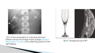 Utuc Presentation UTUC & MUSCLE INVASIVE BLADDER CA POWERPOINT PRESENTATION | PPTX