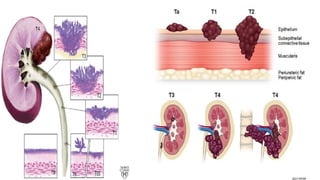 Utuc Ribbon UTUC & MUSCLE INVASIVE BLADDER CA POWERPOINT PRESENTATION | PPTX