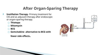 Utuc Presentation UTUC & MUSCLE INVASIVE BLADDER CA POWERPOINT PRESENTATION | PPTX