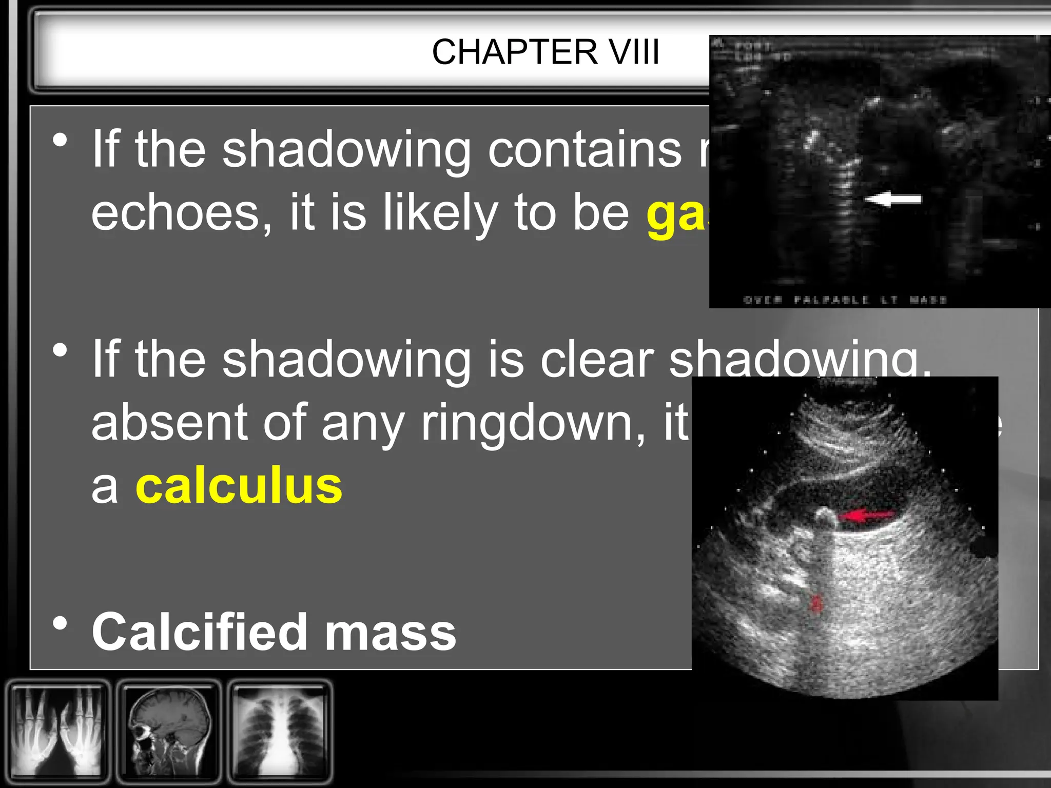 CHAPTER VIII
• If the shadowing contains ringdown
echoes, it is likely to be gas.
• If the shadowing is clear shadowing,
absent of any ringdown, it is likely to be
a calculus
• Calcified mass
 