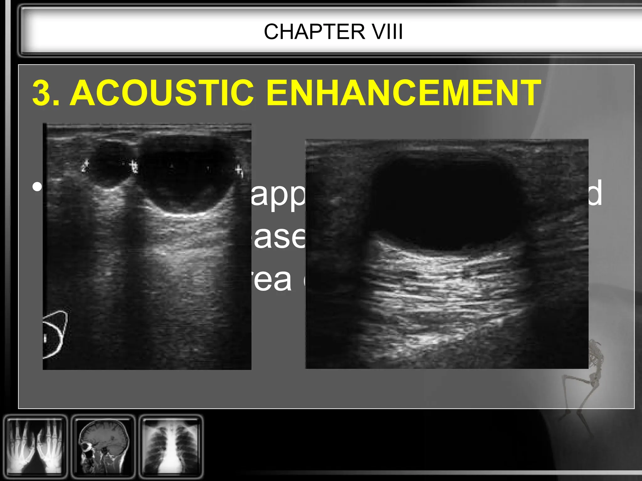 CHAPTER VIII
3. ACOUSTIC ENHANCEMENT
• This artifact appears as a localized
area of increased echo amplitude
behind an area of low attenuation.
 