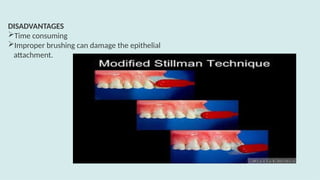 DISADVANTAGES
Time consuming
Improper brushing can damage the epithelial
attachment.
 