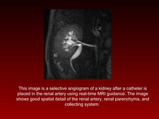This image is a selective angiogram of a kidney after a catheter is
placed in the renal artery using real-time MRI guidance. The image
shows good spatial detail of the renal artery, renal parenchyma, and
collecting system.
 