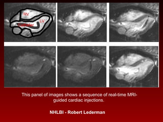 This panel of images shows a sequence of real-time MRI-
guided cardiac injections.
NHLBI - Robert Lederman
 