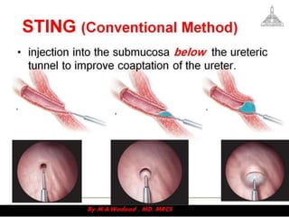 Upper urinary tract reconstruction | PDF
