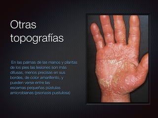 Otras
topografías
En las palmas de las manos y plantas
de los pies las lesiones son más
difusas, menos precisas en sus
bordes, de color amarillento, y
pueden verse entre las
escamas pequeñas pústulas
amicrobianas (psoriasis pustulosa)
 