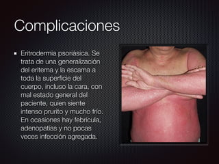 Complicaciones
Eritrodermia psoriásica. Se
trata de una generalización
del eritema y la escama a
toda la superﬁcie del
cuerpo, incluso la cara, con
mal estado general del
paciente, quien siente
intenso prurito y mucho frío.
En ocasiones hay febrícula,
adenopatías y no pocas
veces infección agregada.
 