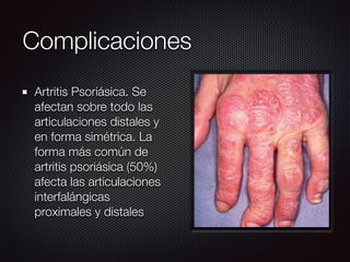 Artritis Psoriásica. Se
afectan sobre todo las
articulaciones distales y
en forma simétrica. La
forma más común de
artritis psoriásica (50%)
afecta las articulaciones
interfalángicas
proximales y distales
Complicaciones
 