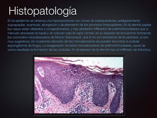 Histopatología
En la epidermis se observa una hiperqueratosis con zonas de paraqueratosis, adelgazamiento
suprapapilar, acantosis, elongación y abultamiento de los procesos interpapilares. En la dermis papilar
los vasos están dilatados y congestionados, y hay alrededor inﬁltrados de polimorfonucleares que a
menudo atraviesan la basal y se colocan bajo la capa córnea, en su espesor se encuentran formando
los conocidos microabscesos de Munro-Sabouraud, que si no son exclusivos de la psoriasis, sí son
muy sugestivos. En ocasiones derivado de los microabscesos se pueden encontrar a pústula
espongiforme de Kogoj. La exageración de estos microabscesos de polimorfonucleares, quizá da
como resultado la formación de las pústulas. En el espesor de la dermis hay un inﬁltrado de linfocitos.
 