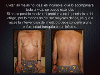 Evitar las malas noticias: es incurable, que lo acompañará
toda la vida, se puede extender.
Si no es posible resolver el problema de la psoriasis o del
vitiligo, por lo menos no causar mayores daños, ya que a
veces la intervención del médico puede convertir a una
enfermedad tranquila en un inﬁerno.
 