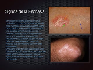 Signos de la Psoriasis
El raspado de dicha escama con una
cucharilla o con la uña da la sensación de
estar raspando una vela de paraﬁna (signo
de la paraﬁna o de la bujía), al ﬁnal queda
una delgada laminilla (membrana de
Duncan-Dulckley), que al desprenderse
como una oblea deja una superﬁcie
tapizada de ﬁno puntilleo sangrante (signo
del rocío, rosa sangrante o signo de
Auspitz) que se considera típico de esta
enfermedad
Otro signo importante en la psoriasis es el
halo de Woronoff, mancha hipocrómica que
rodea a la lesión de psoriasis y que va
ligado al inicio de la regresión de la placa
de psoriasis
 