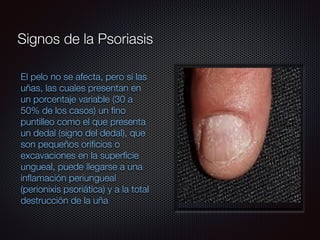 El pelo no se afecta, pero sí las
uñas, las cuales presentan en
un porcentaje variable (30 a
50% de los casos) un ﬁno
puntilleo como el que presenta
un dedal (signo del dedal), que
son pequeños oriﬁcios o
excavaciones en la superﬁcie
ungueal, puede llegarse a una
inﬂamación periungueal
(perionixis psoriática) y a la total
destrucción de la uña
Signos de la Psoriasis
 