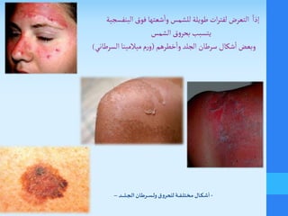 ً‫إذا‬‫البنفسجية‬‫فوق‬ ‫شعتها‬
‫أ‬
‫وا‬ ‫للشمس‬ ‫طويلة‬‫ات‬‫ر‬‫لفت‬ ‫التعر‬
‫يتسبب‬‫الشمس‬‫ق‬‫و‬‫بحر‬
‫وبعض‬‫خطرهم‬
‫أ‬
‫وا‬ ‫الجلد‬ ‫سرطان‬ ‫شكال‬
‫أ‬
‫ا‬(‫ميالمينا‬ ‫م‬‫ر‬‫و‬‫السرطاني‬)
-‫ـد‬‫ـ‬‫ـ‬‫ـ‬‫ـ‬‫ـ‬‫ـ‬‫ـ‬‫ل‬‫ـ‬‫ـ‬‫ـ‬‫ـ‬‫ج‬‫ـ‬‫ل‬‫ا‬ ‫ـان‬‫ط‬‫ـر‬‫ـ‬‫ـ‬‫ـ‬‫س‬‫ـ‬‫ل‬‫و‬ ‫للحروق‬ ‫ـة‬‫ـ‬‫ـ‬‫ـ‬‫ف‬‫ـ‬‫ل‬‫ـ‬‫ت‬‫ـ‬‫خ‬‫ـ‬‫م‬ ‫ـال‬‫ـ‬‫ك‬‫ـ‬‫ش‬‫أ‬–
 