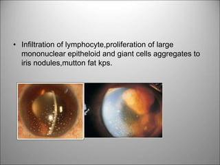 • Infiltration of lymphocyte,proliferation of large
mononuclear epitheloid and giant cells aggregates to
iris nodules,mutton fat kps.
 