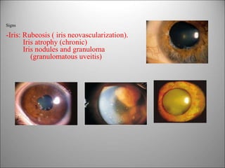 Subtle Rubeosis uvea | PPTX
