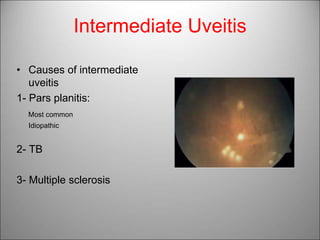 Intermediate Uveitis
• Causes of intermediate
uveitis
1- Pars planitis:
Most common
Idiopathic
2- TB
3- Multiple sclerosis
 