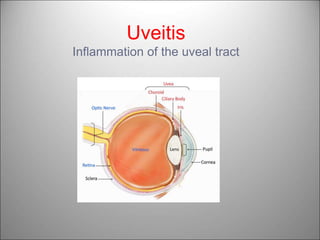 Uveitis
Inflammation of the uveal tract
 