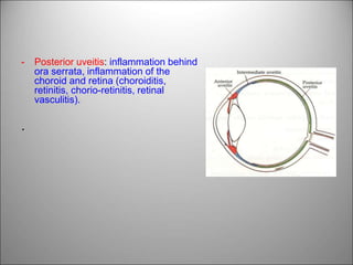- Posterior uveitis: inflammation behind
ora serrata, inflammation of the
choroid and retina (choroiditis,
retinitis, chorio-retinitis, retinal
vasculitis).
.
 