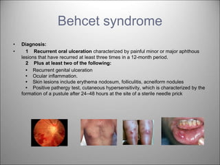 Behcet syndrome
• Diagnosis:
• 1 Recurrent oral ulceration characterized by painful minor or major aphthous
lesions that have recurred at least three times in a 12-month period.
2 Plus at least two of the following:
• Recurrent genital ulceration
• Ocular inflammation.
• Skin lesions include erythema nodosum, folliculitis, acneiform nodules
• Positive pathergy test, cutaneous hypersensitivity, which is characterized by the
formation of a pustule after 24–48 hours at the site of a sterile needle prick
 
