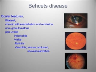 Behcets disease
,
Ocular features;
Bilateral,
chronic with exacerbation and remission,
non- granulomatous
pan-uveitis
iridocyclitis
Vitritis
Retinitis
Vasculitis; venous occlusion,
neovascularization,
 