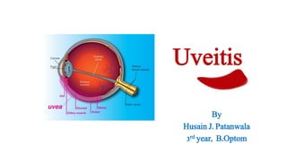 Uveitis 
By 
Husain J. Patanwala 
3rd year, B.Optom 
 