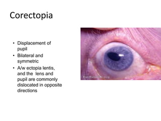 Anatomy and Applied aspects of Uvea | PPTX
