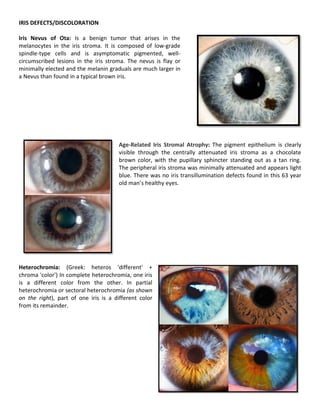 Defect In The Iris Uveal Tract Review | PDF