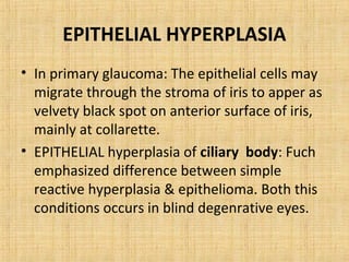 EPITHELIAL HYPERPLASIA
• In primary glaucoma: The epithelial cells may
  migrate through the stroma of iris to apper as
  velvety black spot on anterior surface of iris,
  mainly at collarette.
• EPITHELIAL hyperplasia of ciliary body: Fuch
  emphasized difference between simple
  reactive hyperplasia & epithelioma. Both this
  conditions occurs in blind degenrative eyes.
 