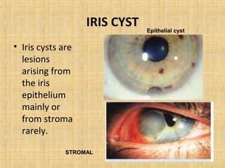 IRIS CYST   Epithelial cyst


• Iris cysts are
  lesions
  arising from
  the iris
  epithelium
  mainly or
  from stroma
  rarely.

              STROMAL
 