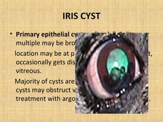 IRIS CYST
• Primary epithelial cysts: u/l or b/l. Solitary or
   multiple may be brown or transparent.
  location may be at pupillary border or iris root,
   occasionally gets dislodged & floats in AC or
   vitreous.
  Majority of cysts are asymptomatic, rarely
   cysts may obstruct vision & requires
   treatment with argon laser photocoagulation.
 