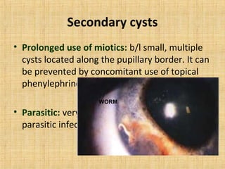 Secondary cysts
• Prolonged use of miotics: b/l small, multiple
  cysts located along the pupillary border. It can
  be prevented by concomitant use of topical
  phenylephrine 2.5%.
                     WORM

• Parasitic: very rarely cysts may develop in
  parasitic infection.
 