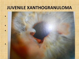 JUVENILE XANTHOGRANULOMA
• Rare idiopathic granulomatous d/s of
  childhood.
• Involves skin,muscle,stomach, salivary glands.
• Iris involvement cause localised or diffuse
  yellow lesion with spontaneous hyphema,
  anterior uveitis or glaucoma
• TOC: topical steroids.
 