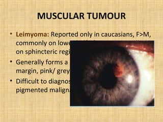 MUSCULAR TUMOUR
• Leimyoma: Reported only in caucasians, F>M,
  commonly on lower half of iris , temporally &
  on sphincteric region.
• Generally forms a sessile mass on pupillary
  margin, pink/ greyish white in colour.
• Difficult to diagnose from a sparsely
  pigmented malignant melanoma.
 