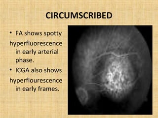 CIRCUMSCRIBED
• FA shows spotty
hyperfluorescence
  in early arterial
  phase.
• ICGA also shows
hyperflourescence
  in early frames.
 