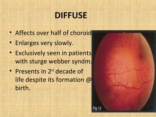 DIFFUSE
• Affects over half of choroid
• Enlarges very slowly.
• Exclusively seen in patients
  with sturge webber syndm.
• Presents in 2nd decade of
  life despite its formation @
  birth.
 
